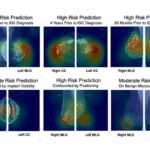 breast cancer risk prediction by AI